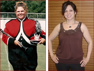 Bariatric surgery results Becca