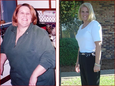 Bariatric surgery results Anne Marie