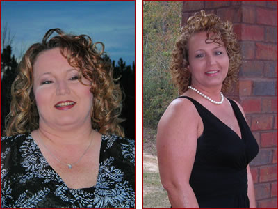 Bariatric surgery results Staci
