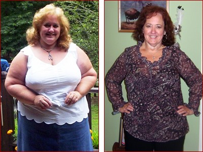 Bariatric Surgery Results Becky