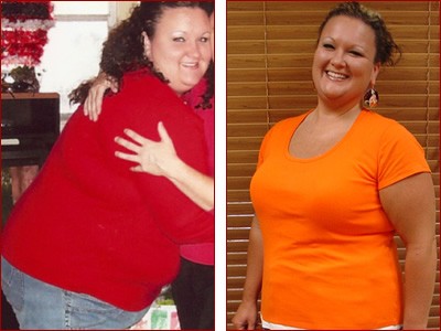 Bariatric Surgery Results for Stephanie