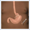 Gastric band injection port