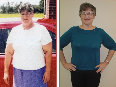 Bariatric Surgery Results Shirley