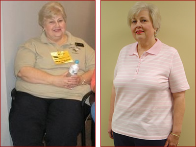 Bariatric Surgery Results Jane