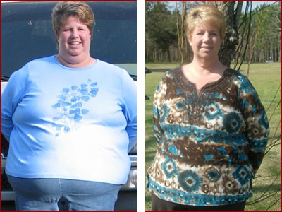 Bariatric Surgery Results Tammie