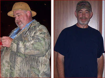 Bariatric surgery results johnny