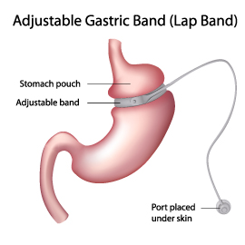 LAP-BAND Surgery