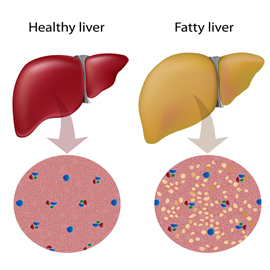 Understanding-Fatty-Liver-Disease