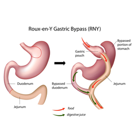 Gastric Bypass Surgery for Weight Control