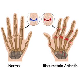 Obesity and Rheumatoid Arthritis in Women