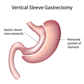 About Gastric Sleeve Surgery