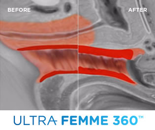 Ultra FEMME 360